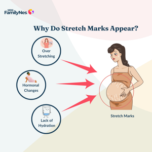 stretch_marks_1160_x_870_px