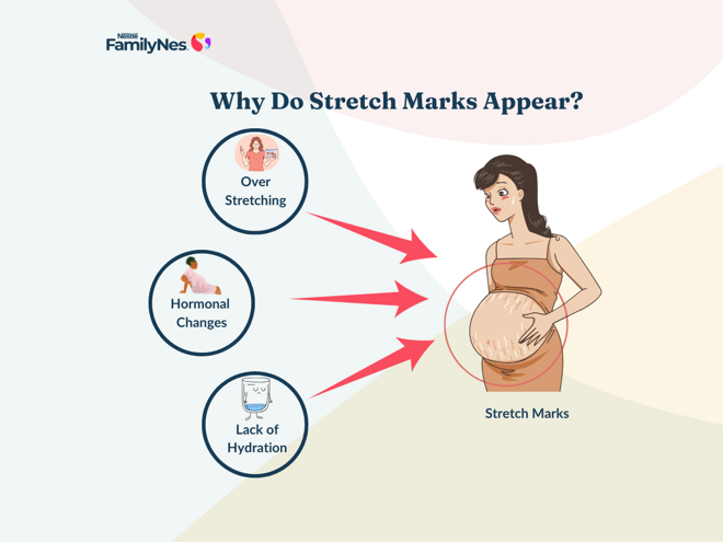 stretch_marks_1160_x_870_px stretch_marks_1160_x_870_px