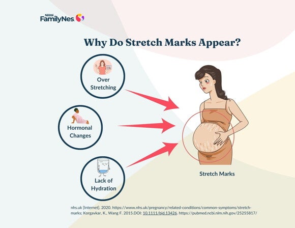 stretch_marks stretch_marks